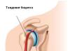 Разрывы сухожилий бицепса плеча Причины смещения головки двуглавой мышцы бицепса